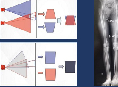 拍攝全脊柱X光片 長骨拼接技術和一板成像的區(qū)別