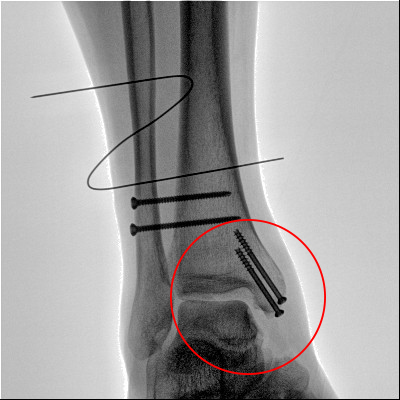 【醫(yī)療科普】之內(nèi)踝骨折