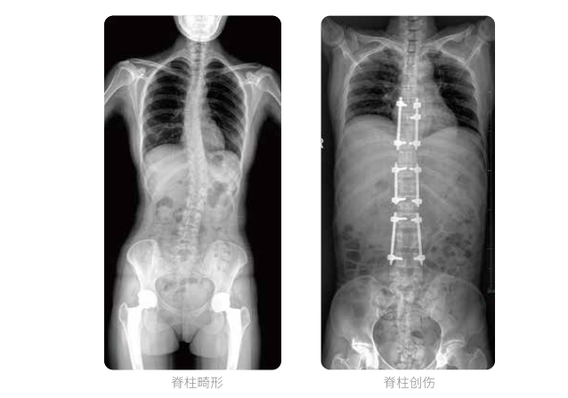 動(dòng)態(tài)DR的全脊柱臨床影像