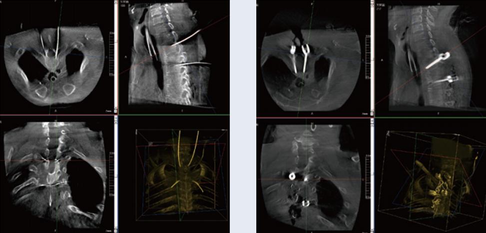 術(shù)中三維C形臂影像在脊柱導(dǎo)航機(jī)器人系統(tǒng)中的應(yīng)用